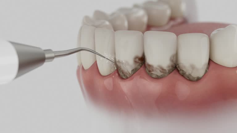 Trusted Teeth Cleaning And Checkup service in Louisiana, MO - Dentist Open Now